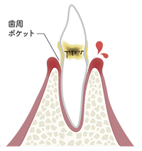 歯周炎（軽度）