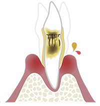 歯周炎（重度）